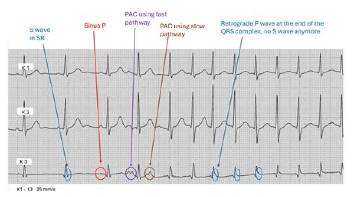 Would endocarditis show on EKG?